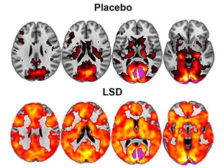 Placebo vs. LSD